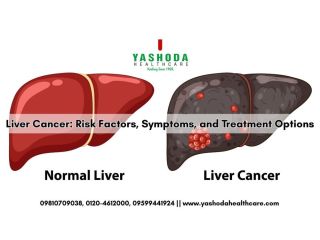 best-hospital-for-liver-cancer-small-0