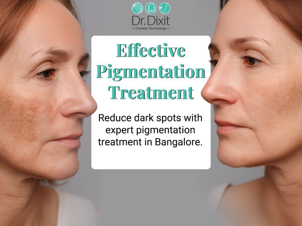 pigmentation-treatment-in-bangalore-big-0