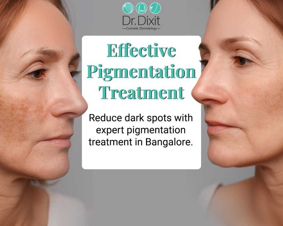 pigmentation-treatment-in-bangalore