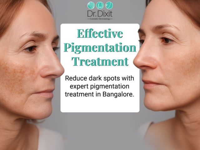 pigmentation-treatment-in-bangalore