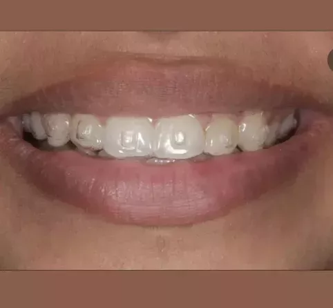 invisible-braces-koparkhairane-clear-aligners-for-perfect-smile-big-0