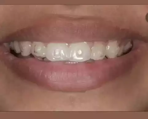 invisible-braces-koparkhairane-clear-aligners-for-perfect-smile