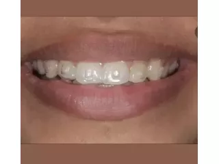 invisible-braces-koparkhairane-clear-aligners-for-perfect-smile-small-0