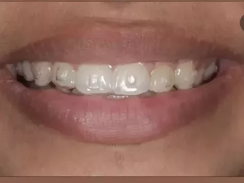 invisible-braces-koparkhairane-clear-aligners-for-perfect-smile
