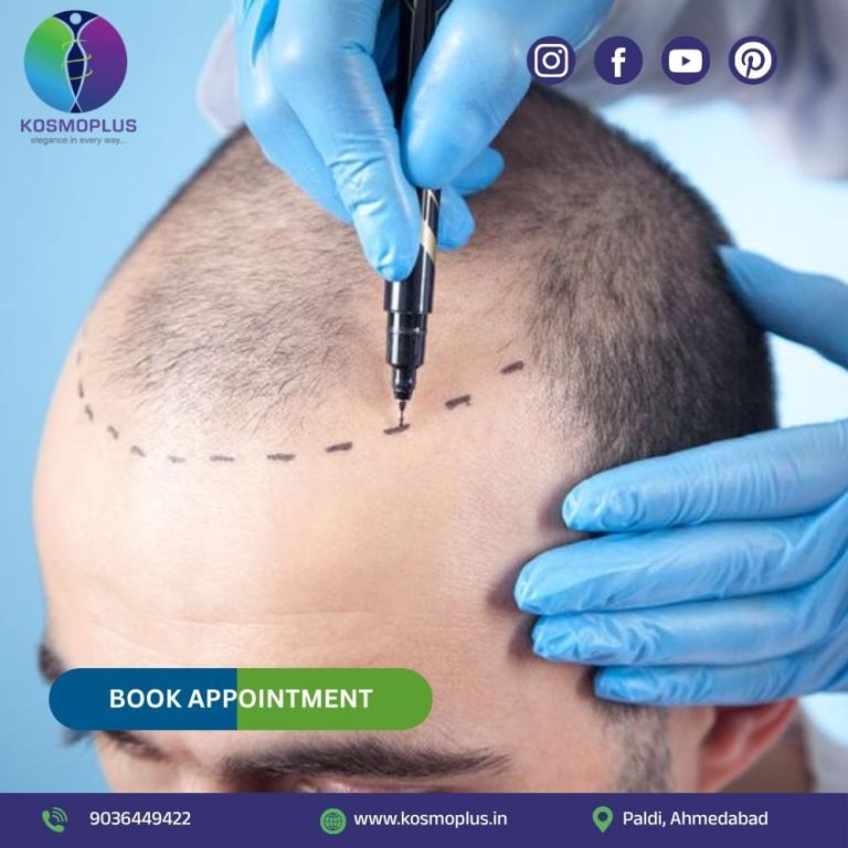 get-safe-and-trusted-care-with-hair-transplant-in-ahmedabad-big-0