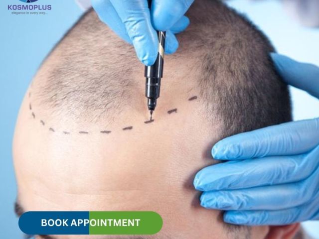 get-safe-and-trusted-care-with-hair-transplant-in-ahmedabad