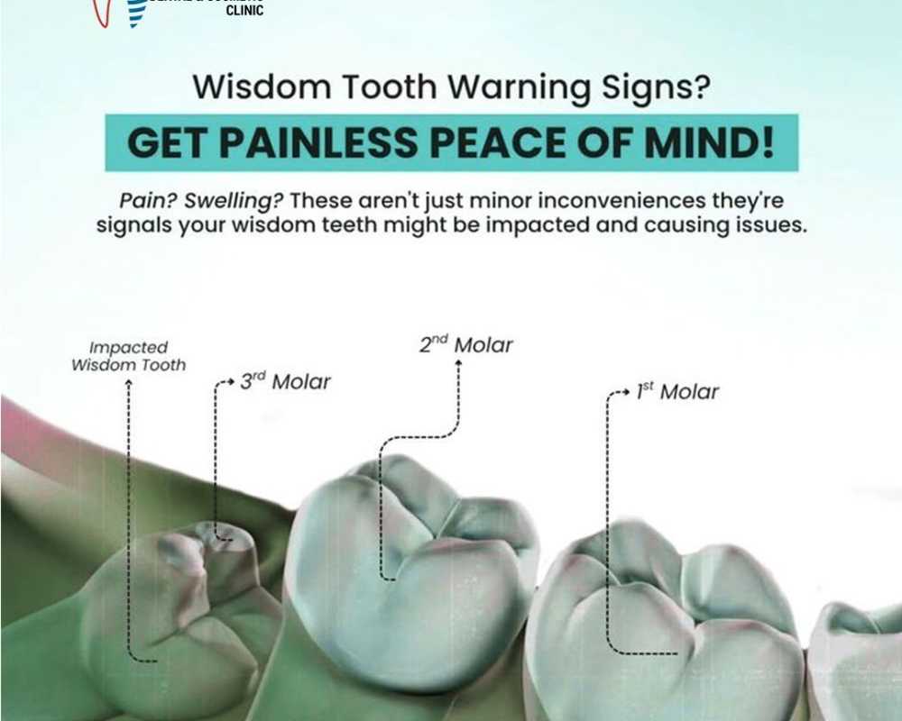 wisdom-teeth-removal-near-me-for-safe-surgical-treatment