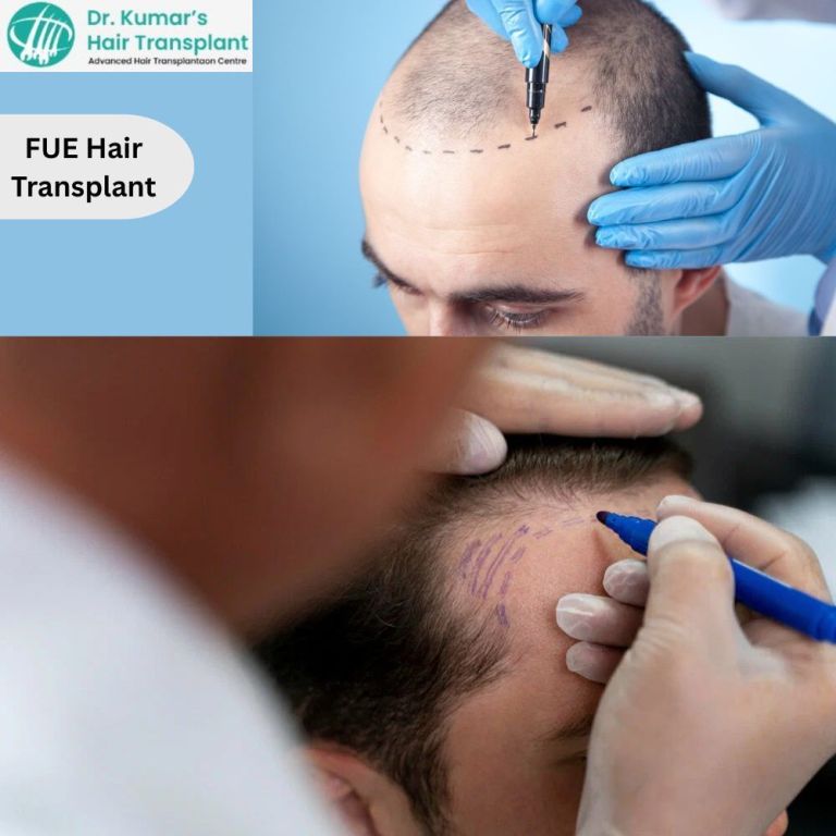 trusted-fue-hair-transplant-clinic-in-hyderabad-for-hair-thinning-big-0