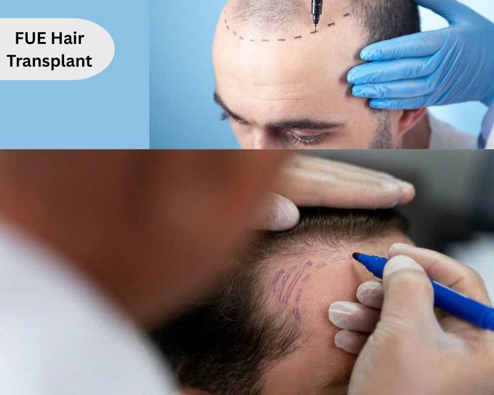 trusted-fue-hair-transplant-clinic-in-hyderabad-for-hair-thinning