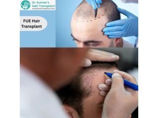 trusted-fue-hair-transplant-clinic-in-hyderabad-for-hair-thinning-small-0