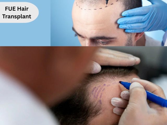 trusted-fue-hair-transplant-clinic-in-hyderabad-for-hair-thinning