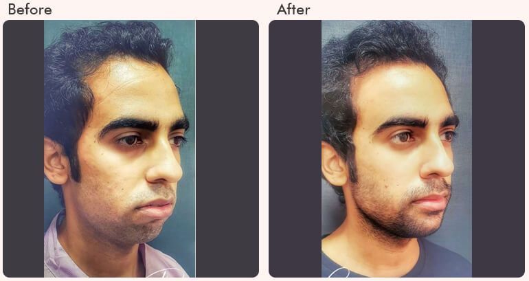 chin-augmentation-in-delhi-dr-rajat-gupta-big-0