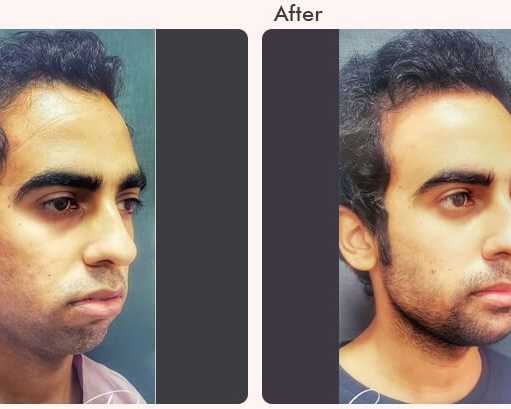 chin-augmentation-in-delhi-dr-rajat-gupta