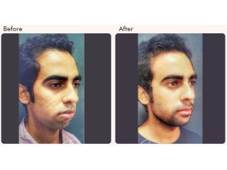 chin-augmentation-in-delhi-dr-rajat-gupta-small-0