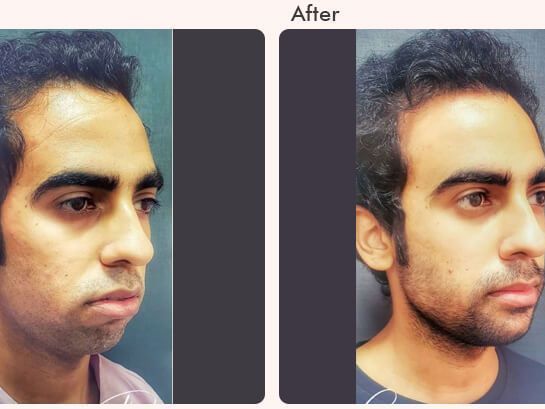 chin-augmentation-in-delhi-dr-rajat-gupta