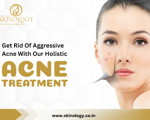 why-acne-keeps-coming-back-and-how-to-control-it-effectively