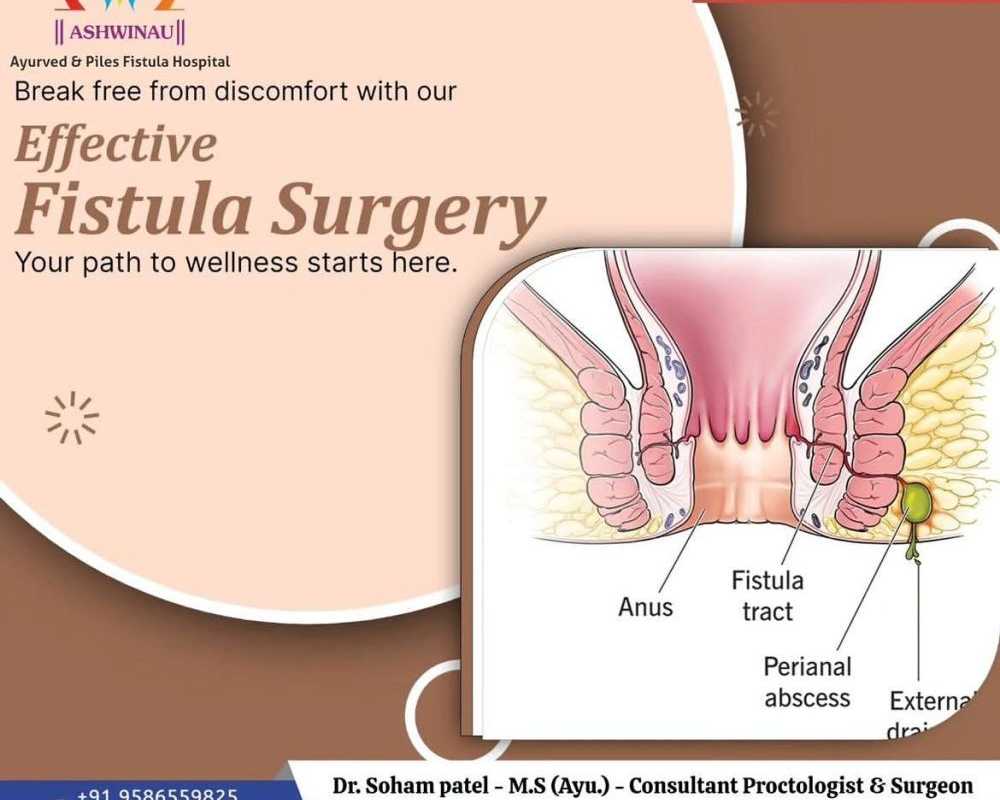 fistula-treatment-in-ahmedabad-at-ashwinau-hospital