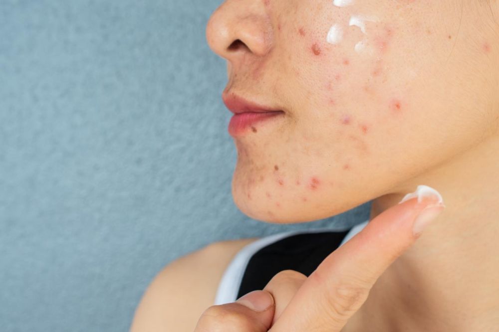 acne-treatment-in-noida-clear-skin-solutions-by-expert-big-0