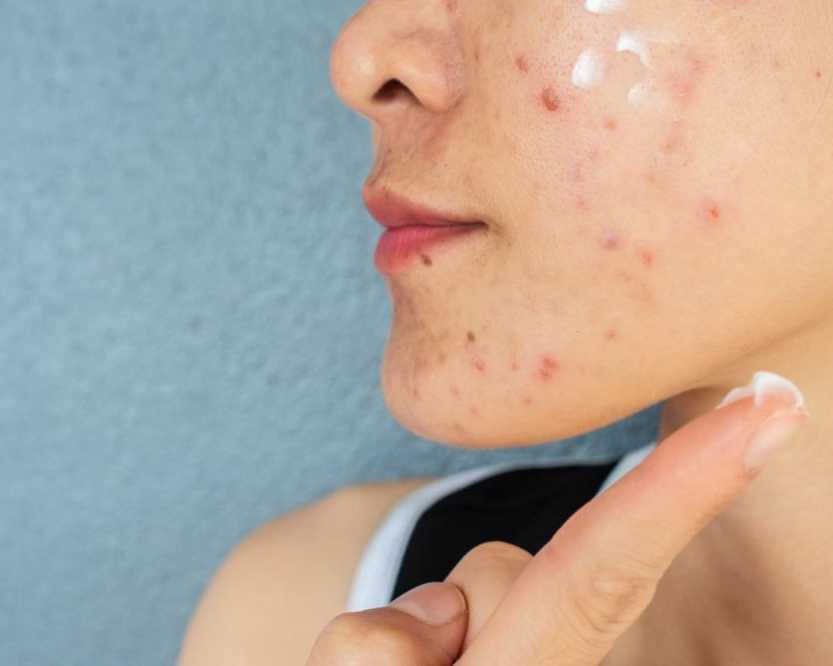 acne-treatment-in-noida-clear-skin-solutions-by-expert
