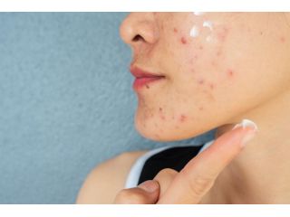 acne-treatment-in-noida-clear-skin-solutions-by-expert-small-0