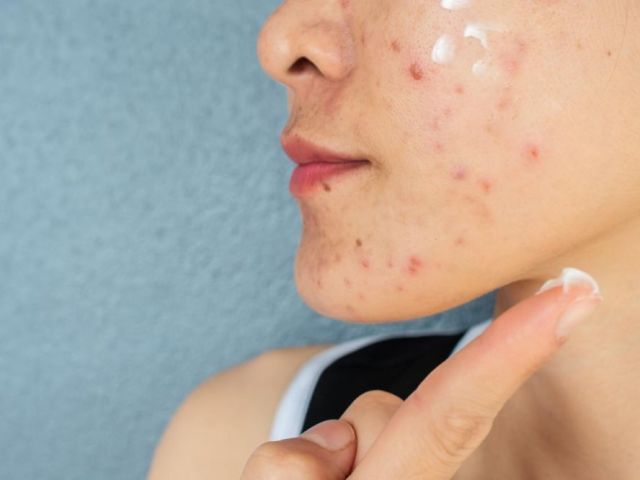 acne-treatment-in-noida-clear-skin-solutions-by-expert