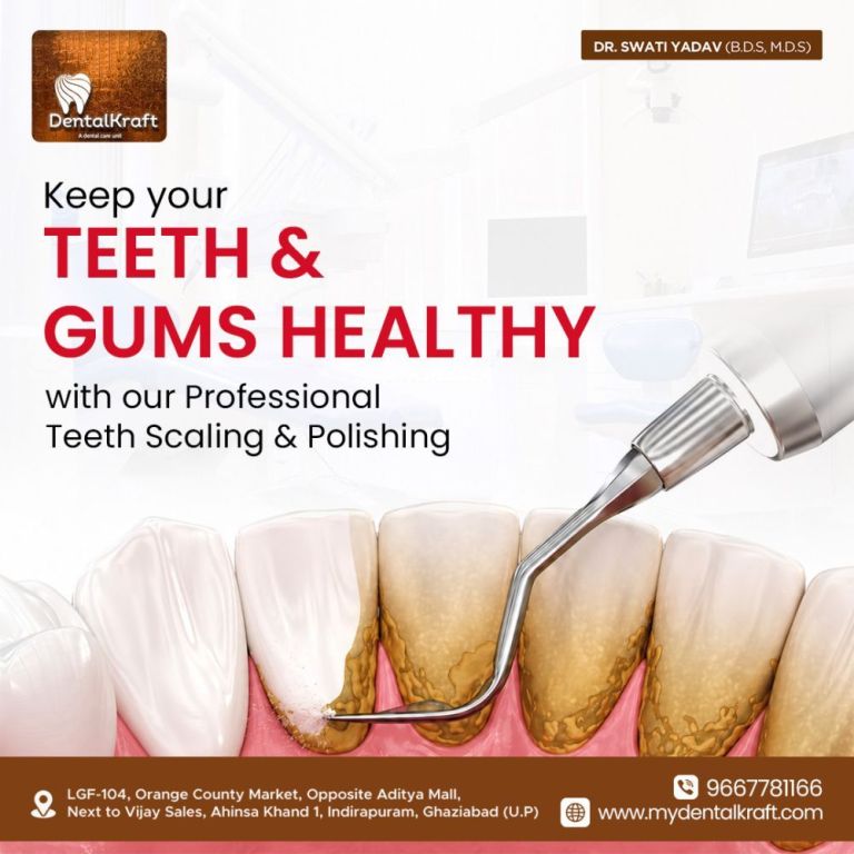 teeth-whitening-treatment-in-indirapuram-big-0