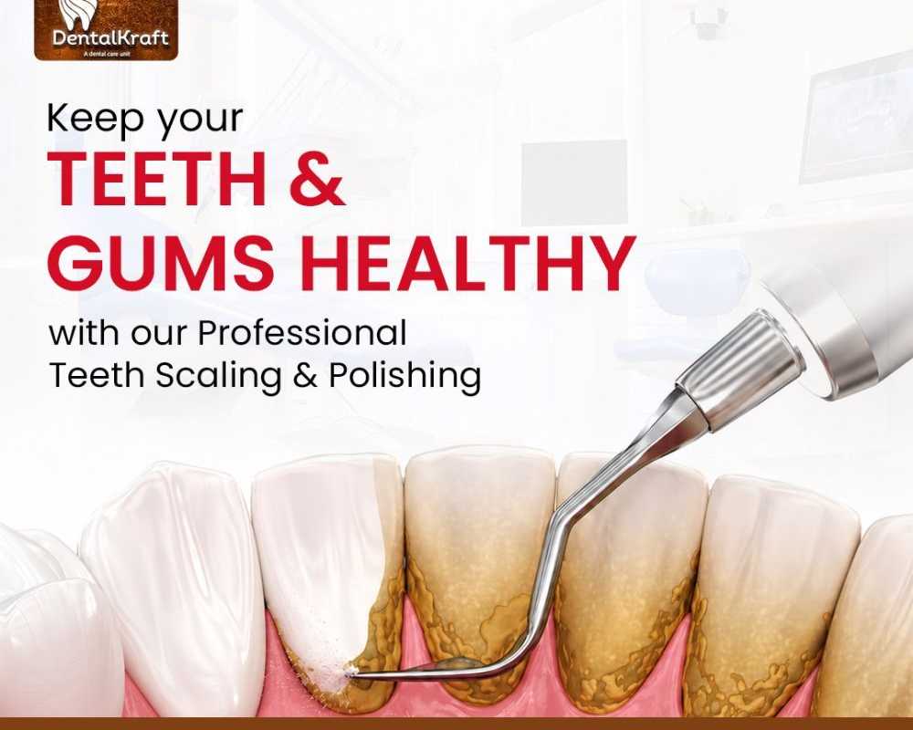 teeth-whitening-treatment-in-indirapuram