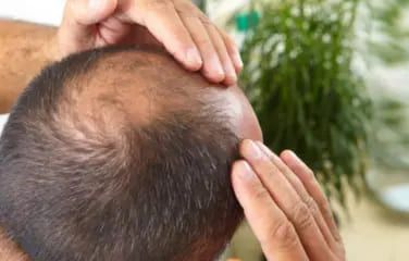 best-hair-fall-hair-loss-treatment-in-coimbatore-big-0