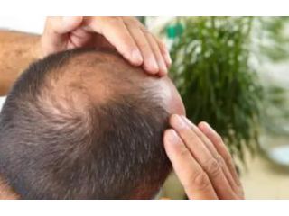 best-hair-fall-hair-loss-treatment-in-coimbatore-small-0