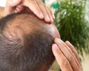 best-hair-clinic-for-anti-dandruff-treatment-in-coimbatore