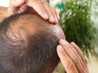 best-hair-clinic-for-anti-dandruff-treatment-in-coimbatore