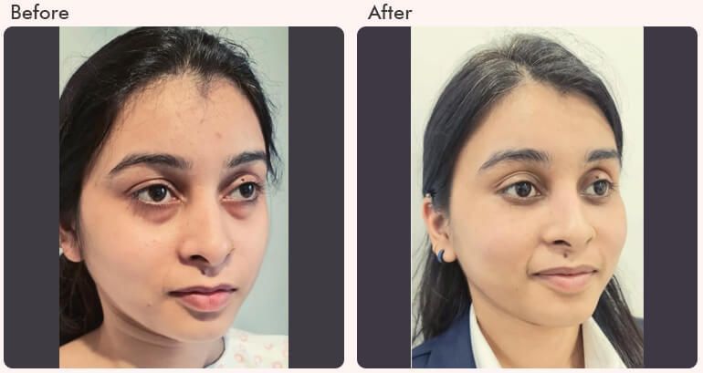 eyelid-surgery-in-delhi-dr-rajat-gupta-big-0