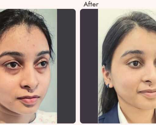 eyelid-surgery-in-delhi-dr-rajat-gupta