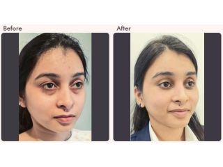 eyelid-surgery-in-delhi-dr-rajat-gupta-small-0