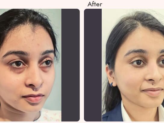 eyelid-surgery-in-delhi-dr-rajat-gupta