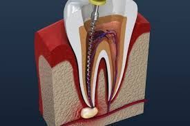 expert-root-canal-treatment-in-chetla-for-healthy-smile-big-0