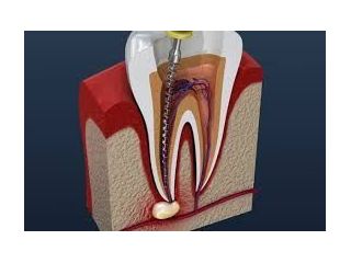 expert-root-canal-treatment-in-chetla-for-healthy-smile-small-0