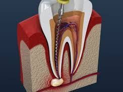 expert-root-canal-treatment-in-chetla-for-healthy-smile