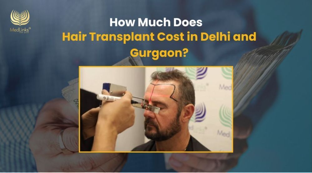 affordable-cost-of-hair-transplant-in-delhi-medlinks-clinic-big-0