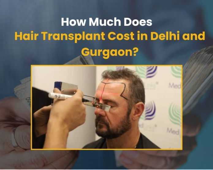 affordable-cost-of-hair-transplant-in-delhi-medlinks-clinic