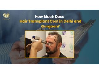 affordable-cost-of-hair-transplant-in-delhi-medlinks-clinic-small-0