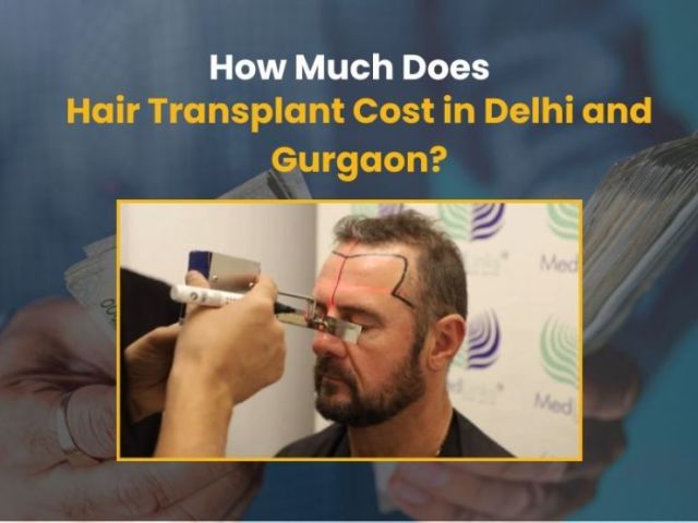 affordable-cost-of-hair-transplant-in-delhi-medlinks-clinic