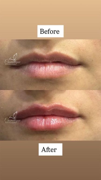lip-filler-treatment-in-amritsar-cosmetique-by-simrat-sandhu-big-0