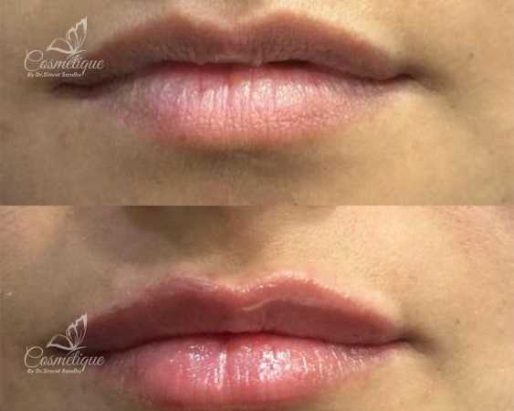lip-filler-treatment-in-amritsar-cosmetique-by-simrat-sandhu