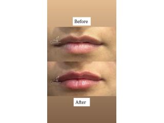 lip-filler-treatment-in-amritsar-cosmetique-by-simrat-sandhu-small-0