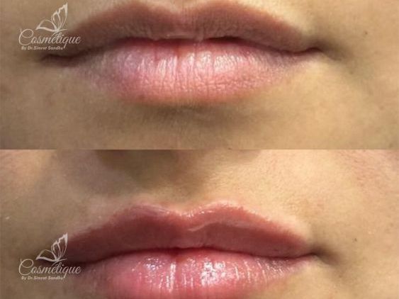 lip-filler-treatment-in-amritsar-cosmetique-by-simrat-sandhu