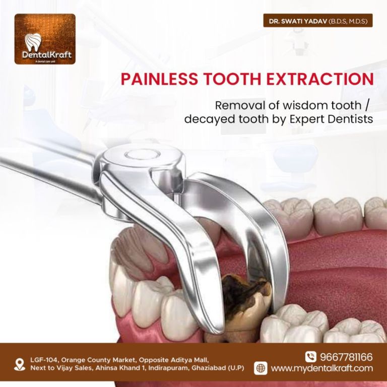 best-dentist-for-tooth-extraction-in-indirapuram-for-safe-care-big-0