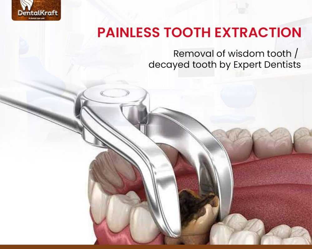 best-dentist-for-tooth-extraction-in-indirapuram-for-safe-care