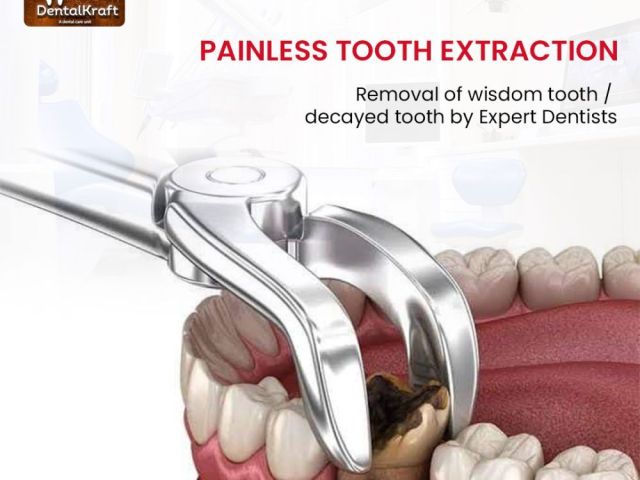 best-dentist-for-tooth-extraction-in-indirapuram-for-safe-care