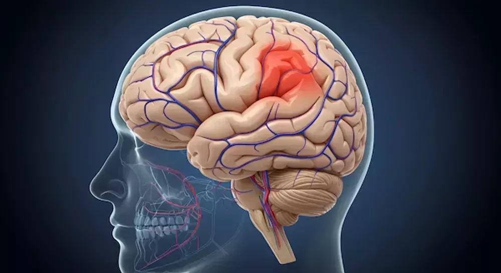 comprehensive-guide-to-brain-hemorrhage-treatment-big-0